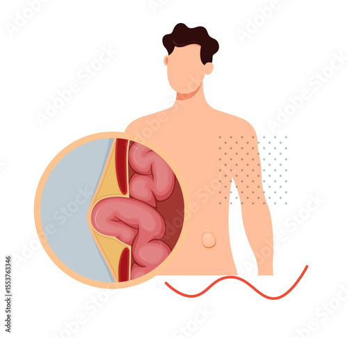 Strangulated Hernia -  Section of the Small Intestines - Stock Illustration