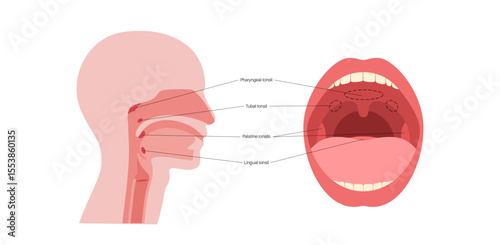 Adenoid medical poster