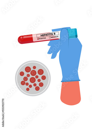 Hand holding blood sample for Hepatitis B test stock illustration