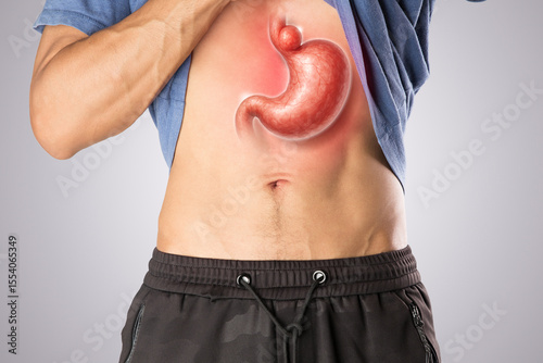 A Hiatal Hernia is illustrated with a line drawing showing the body’s internal symptom part of the stomach pushing through the diaphragm into the chest cavity. Stomachache. 