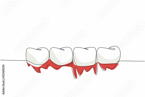 Single one line drawing 4 teeth in a row with bleeding gums. Due to vitamin C deficiency. Inflammation of the gums. International Scurvy Awareness Day. Continuous line design graphic illustration