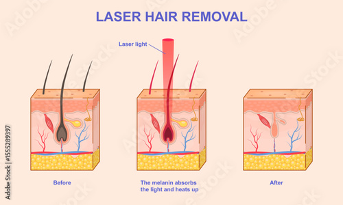 Laser hair removal. Infographics showing layers of skin and process of hair removal using laser beam. Cosmetology procedure. Isometric 3D vector illustration collection isolated on background