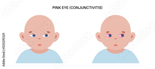 Conjunctivitis medical poster