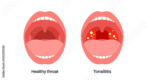 Tonsillitis Oral Desease