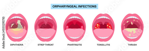 Oropharyngeal infections poster