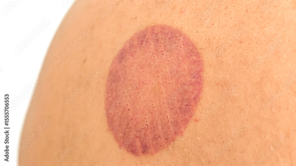 Fototapeta premium Circular Discoloration on Skin Depicting Cupping Therapy Markings Post Treatment Session