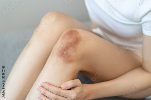 Close up of stain bruise wound on arm, contusion asian young woman, girl an accident fell down stairs, hand on knee in healing injury by massage hematoma blood