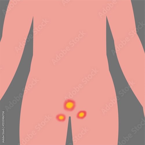 human genetial infection  disease concept illustration science medical design.eps
