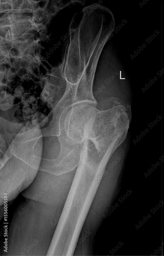Fototapeta premium X-ray of the left hip joint, including the femoral head, acetabulum, and surrounding pelvis. showing hip fracture 