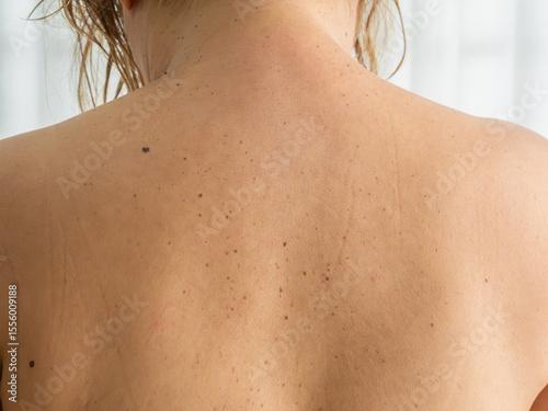 Wallpaper Mural Naked back of an Asian woman with freckles, aging spots, moles, brown warts and wrinkles with white background. Torontodigital.ca