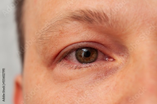 A close-up of an eye exhibiting symptoms of conjunctivitis, with visible redness and irritation.
