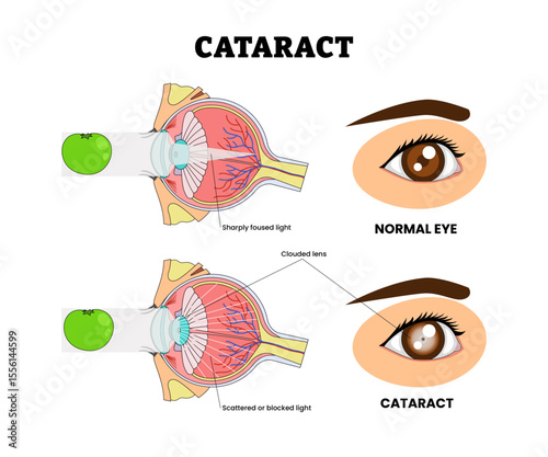 Cataract or Clouding Eye Lens, Eye Vision Problem, Eye Disease for Educational Medical Poster Design Healthcare Scheme, Eye Illness and Eyesight Problem,  Medical Retina Health.