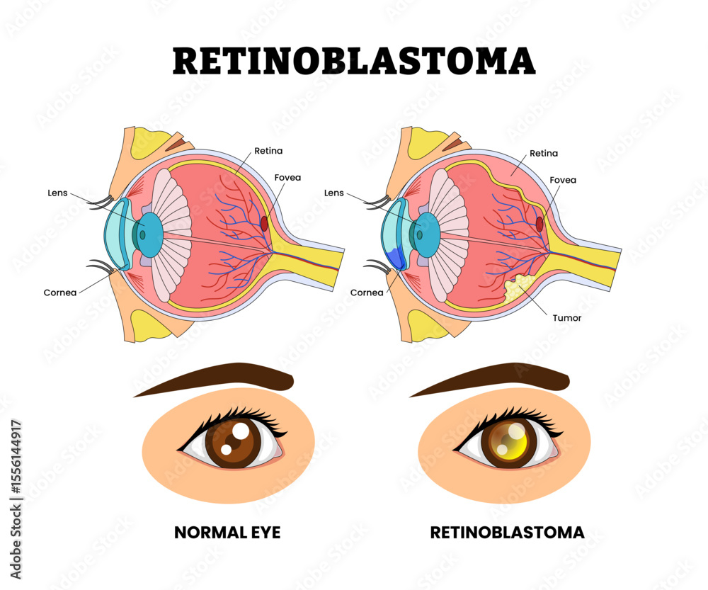 Fototapeta premium Retinoblastoma Rare Eye Cancer, Eye Vision Problem, Eye Disease for Educational Medical Poster Design Healthcare Scheme, Eye Illness and Eyesight Problem, Medical Retina Health. Fovea
