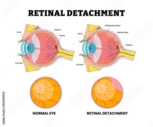 Retinal Detachment Eye Vision Problem, Eye Disease for Educational Medical Poster Design Healthcare Scheme, Eye Illness and Eyesight Problem,  Medical Retina Health, Labeled Retinal Tear.