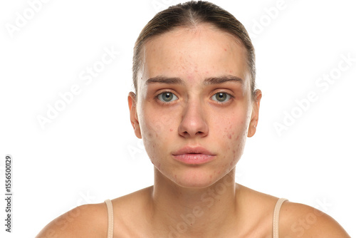 Studio shot of young woman with acne looking slightly worried, face skin condition, skincare concept