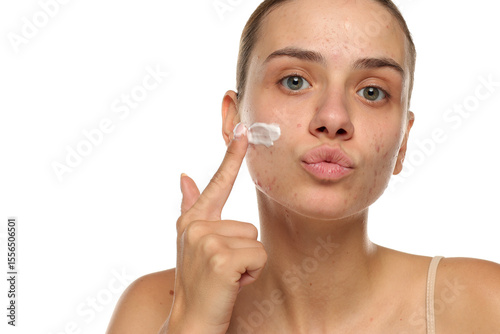 Playful young woman with acne applying cream to her cheek, studio shot on white background