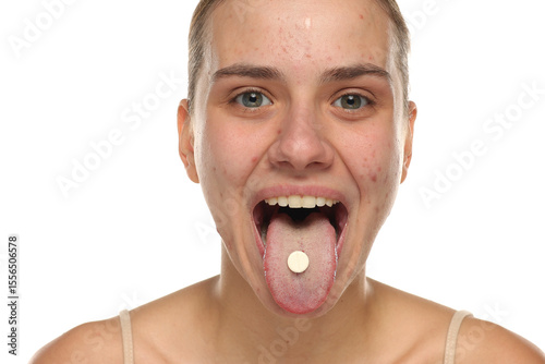 Happy young woman with acne showing pill on tongue, studio shot on white background.