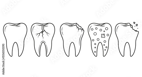 Illustration of the progression of tooth decay, from healthy to severely damaged