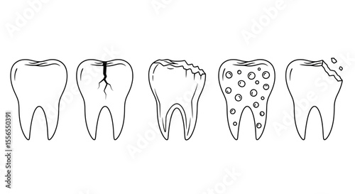 Vector line art collection illustrating the stages of tooth decay, showing progression from a healthy molar to a cracked and cavitated tooth