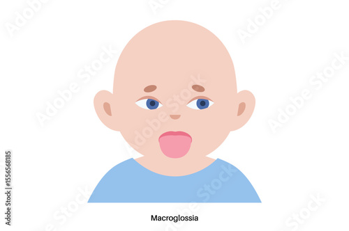 Macroglossia medical poster