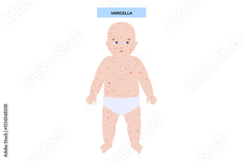 Varicella medical poster