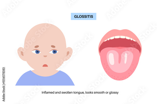 Glossitis medical poster
