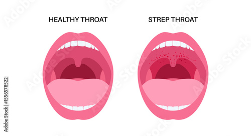 Strep throat poster
