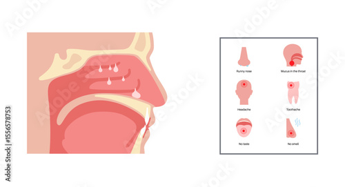 Nasal Polyps poster