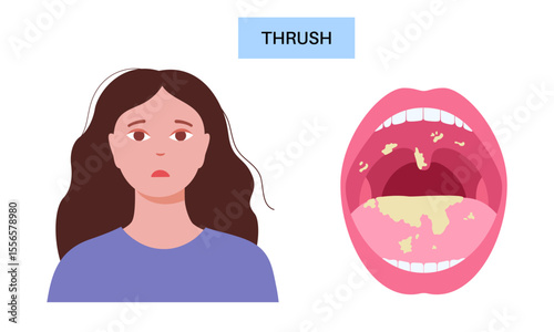 Thrush disease poster