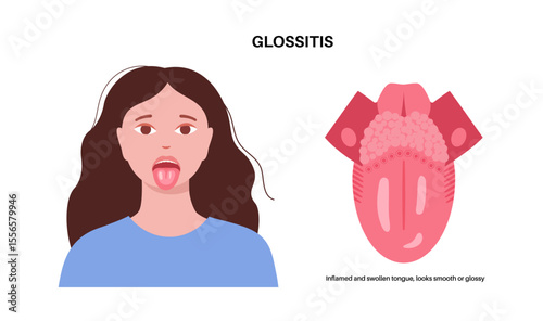 Glossitis medical poster