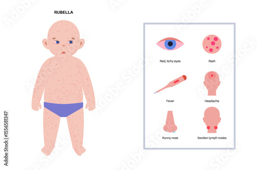 Measles or rubeola symptoms