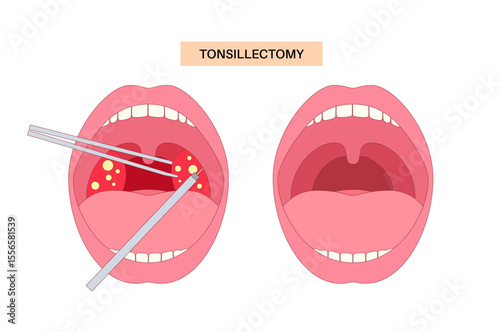 Tonsillectomy procedure poster