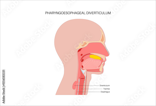 Pharyngoesophageal diverticulum poster