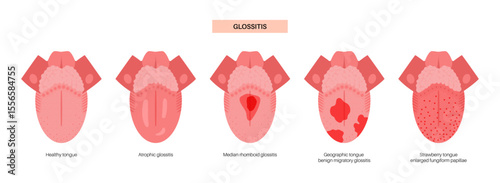 Tongue disease poster