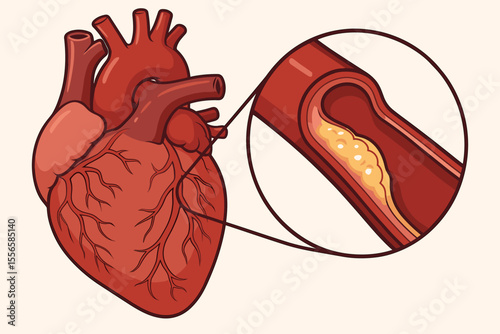 Human heart anatomy with coronary artery cross-section showing atherosclerosis, cholesterol plaque buildup, cardiovascular disease, artery blockage, heart health, medical vector illustration