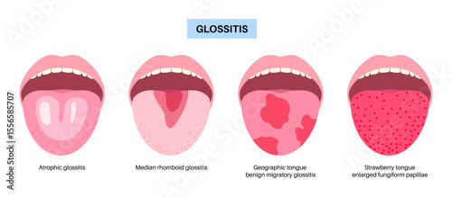 Tongue disease poster