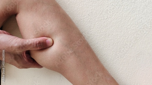 close up the hand holding the flabbiness and adipose, varicose veins and spider, overweight and tummy, cramp and bulging , problem circulation of blood, health care and beauty concept.