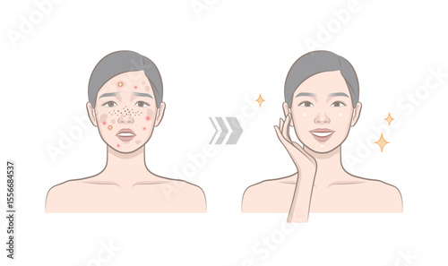 Before and after of woman character with skin trouble as pimple, blackhead, whitehead, zit, blemish, acne, freckle, papule and woman with clear and clean skin. Portrait of cosmetic female model.