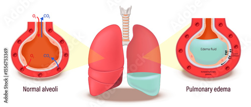 Pulmonary edema. Comparison between normal alveoli and pulmonary edema. Lung diseases anatomy. Human respiratory system.
