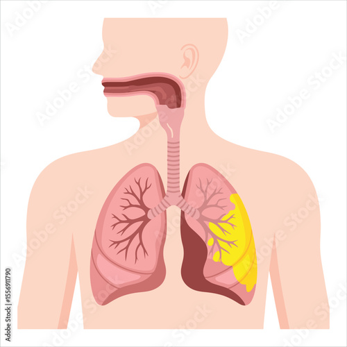 Illustration of the human respiratory system showing healthy and diseased lung areas