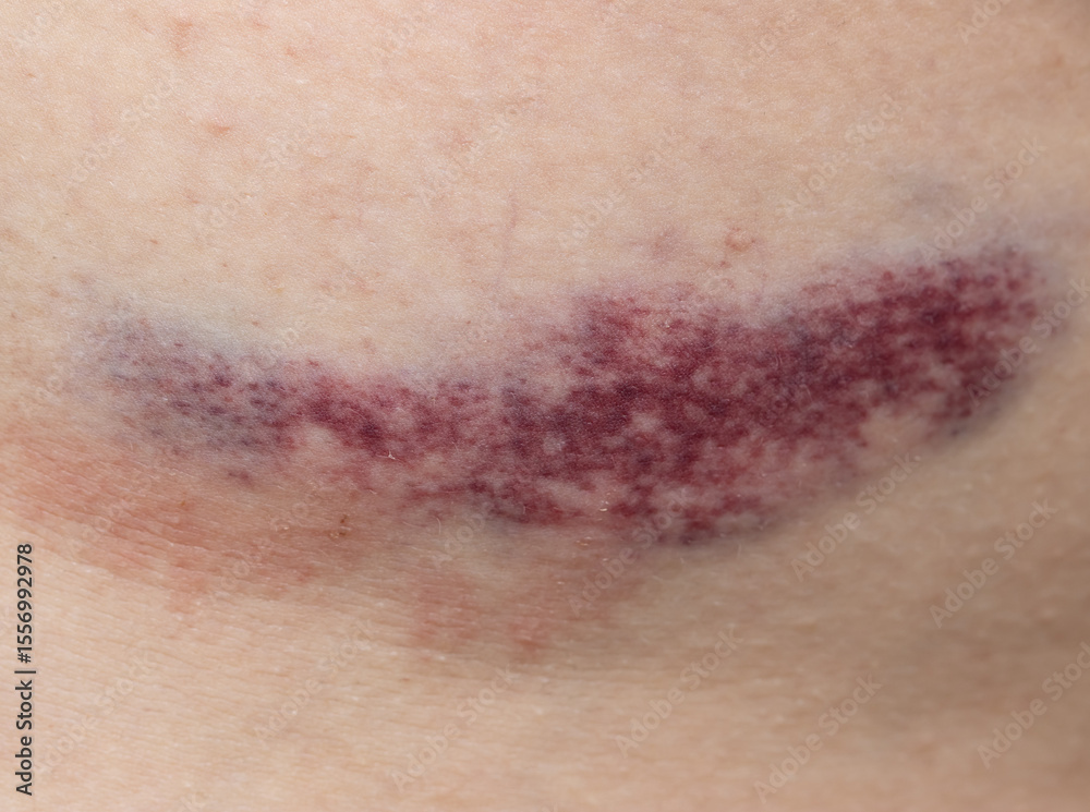 Fototapeta premium A bruise on a person's arm