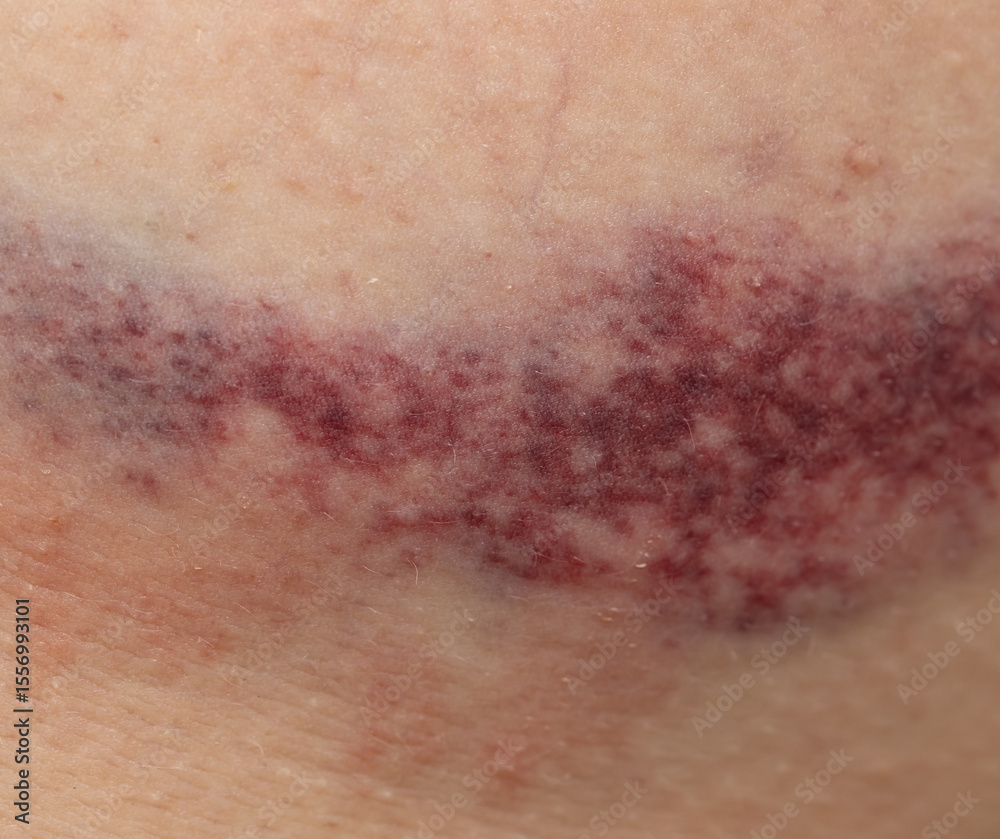 Fototapeta premium A bruise on a person's arm