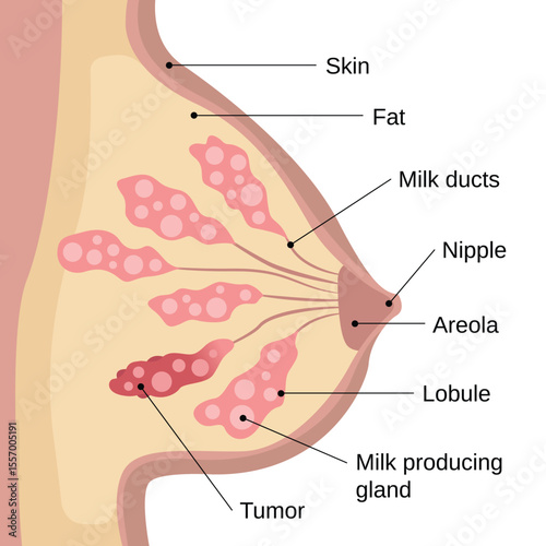 breast cancer vector art