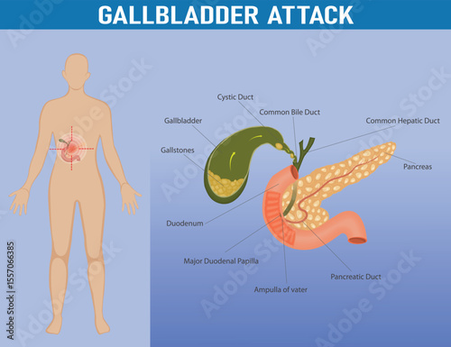 Medical illustration of gallbladder attack anatomy. Detailed medical diagram showing gallbladder, gallstones, ducts, and pancreas, highlighting anatomy and pain location of gallbladder attack.

