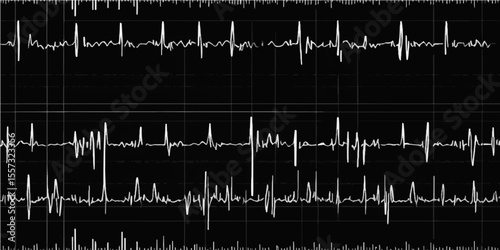 ECG cardiogram showing a green heart rate wave on a medical monitor