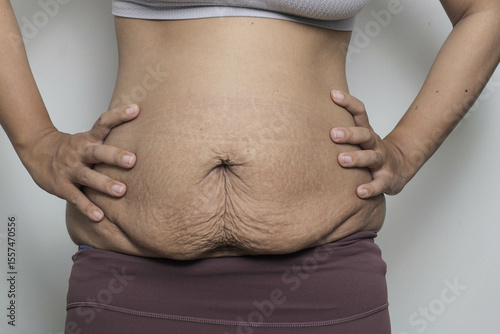 woman postpartum belly with stretch marks, problem after giving birth. promoting body positivity and the reality of motherhood