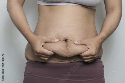 woman squeeze her postpartum belly with stretch marks, problem after giving birth. promoting body positivity and the reality of motherhood