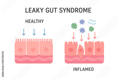 The concept of Leaky Gut Syndrome is depicted in a comparison of healthy and inflamed tissue cells in the gastrointestinal tract, along with toxins and viruses, in a cartoon flat vector illustration