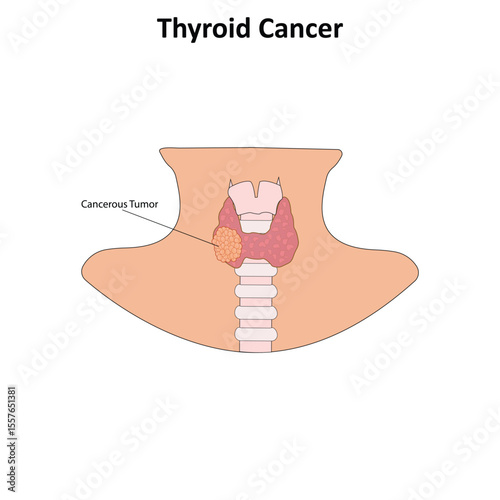 Thyroid cancer vector illustration