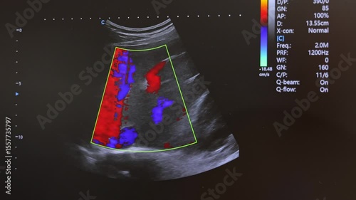 Color Doppler Ultrasound Examination Display, Real-Time Blood Flow Visualization on Monitor Screen